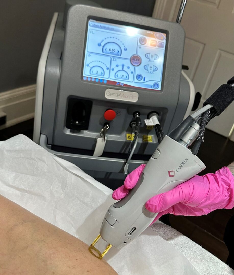 Candela GMax Pro Laser Hair Removal Newmarket, ON